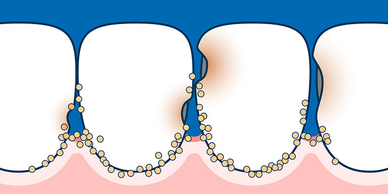 caries-dental-en-bebes