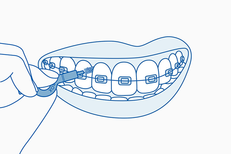 cepillado-con-cepillos-interdentales