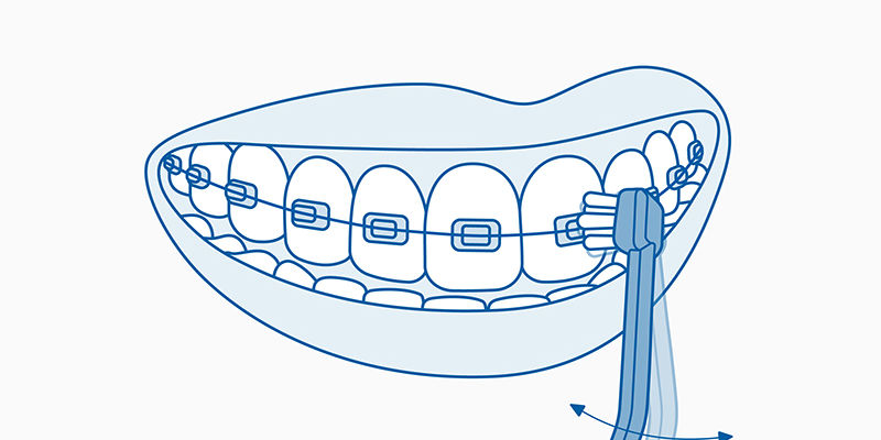 cepillado-de-brackets