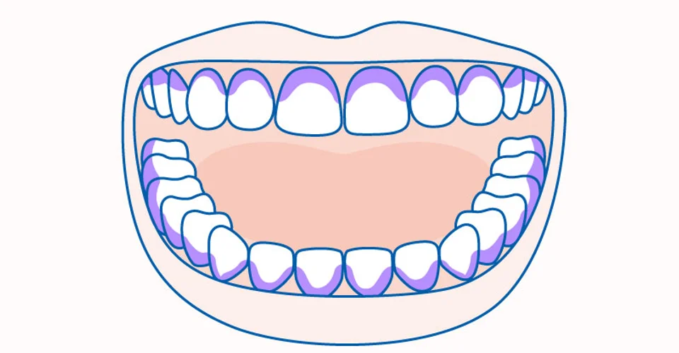 dibujo-dientes-partes-dificil-acceso-en-cepillado