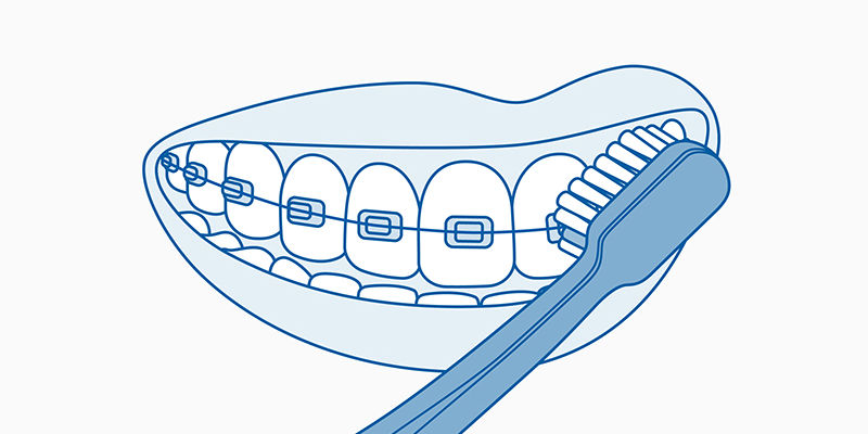 ilustracion-lavado-con-brackets